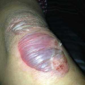 Jonathon's knee.